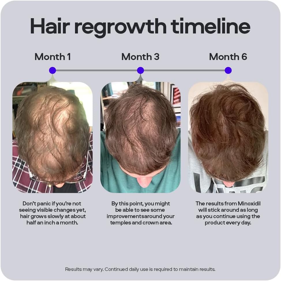 Sons Minoxidil 5% Spray (3x60ml), Hair Regrowth Treatment for Men