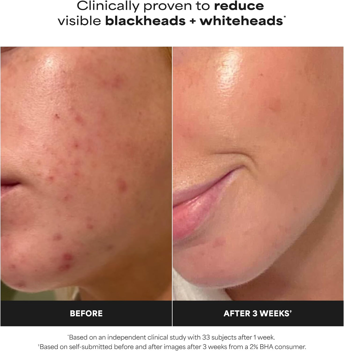 Paula's Choice Skin Perfecting 2% BHA Liquid Exfoliant