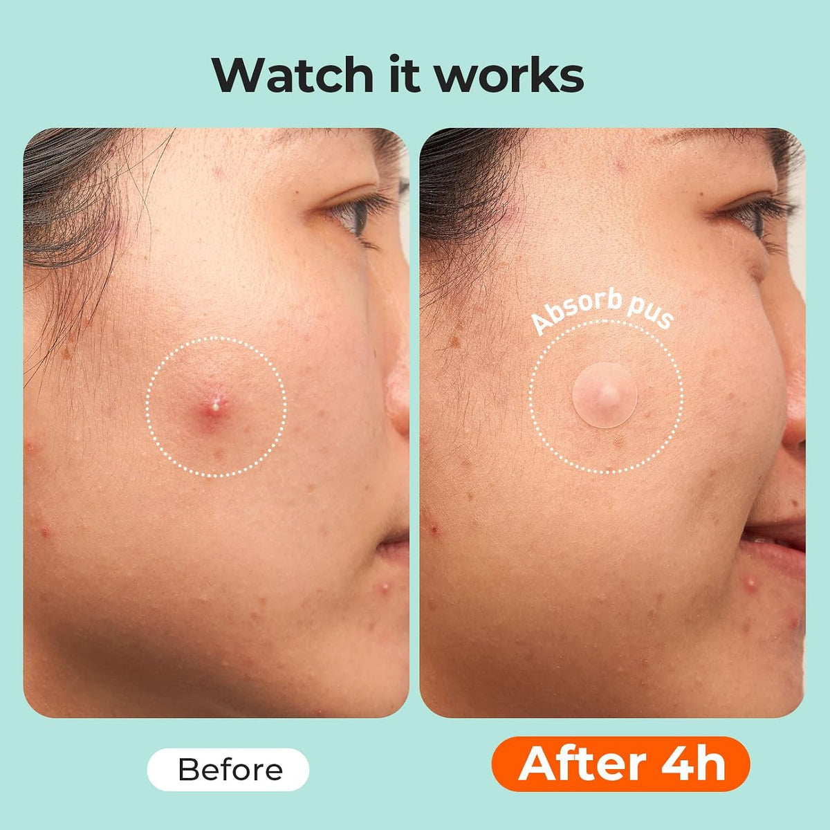 TKTK 443 Count Pimple Patches for Face, Hydrocolloid Spot Stickers, 5 Sizes