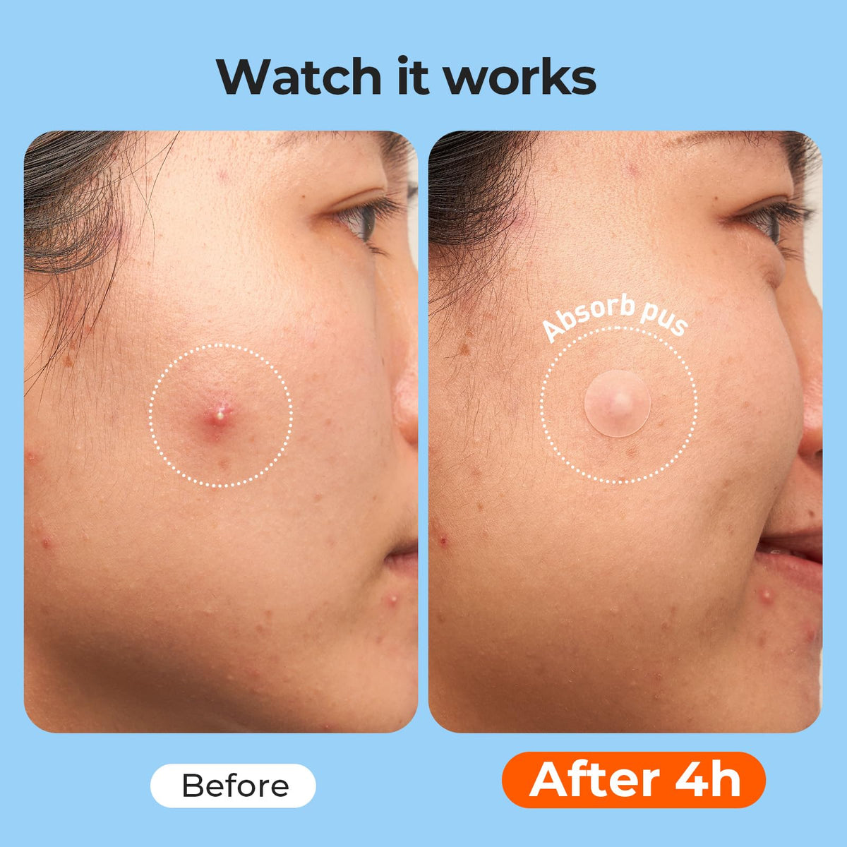 TKTK 443 Count Pimple Patches for Face, Hydrocolloid Spot Stickers, 5 Sizes