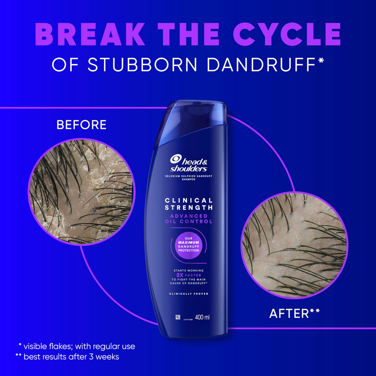 Head & Shoulders Classic Clean 2in1 Anti Dandruff Shampoo, 1000ml. Up to 100% Flake Free, Clinically Proven. For Any Hair and Scalp Type. For Daily use. Clean Feeling