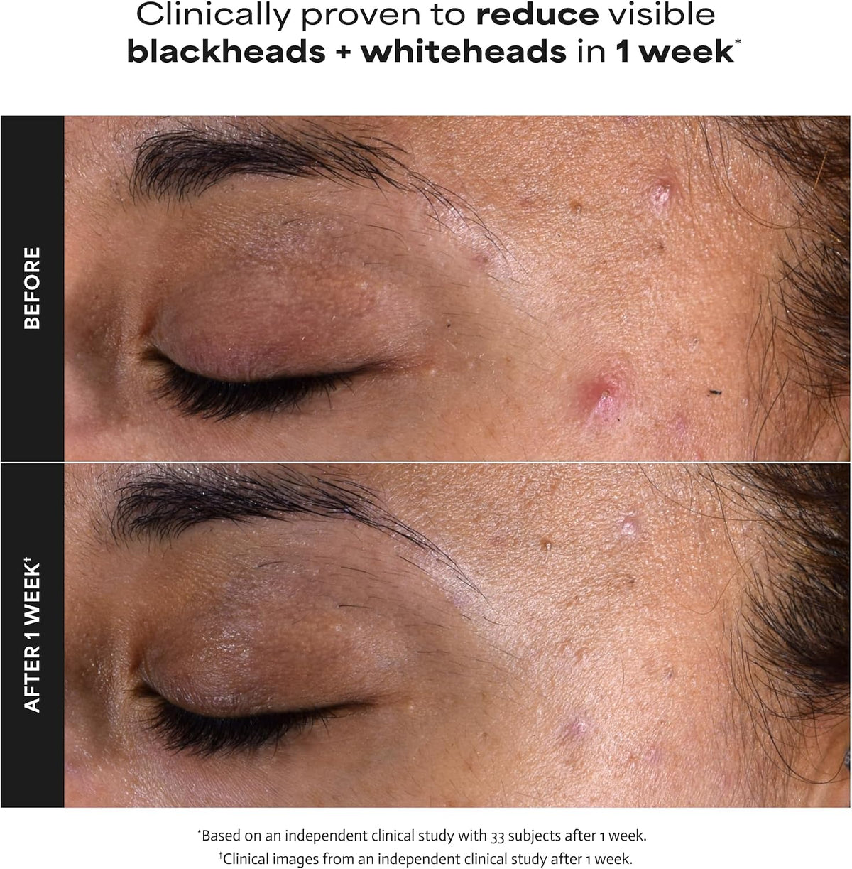 Paula's Choice Skin Perfecting 2% BHA Liquid Exfoliant